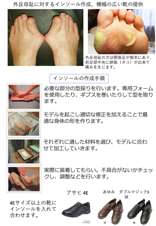 外反母趾を楽にしたい インソール治療と靴の選定 或る形成外科
