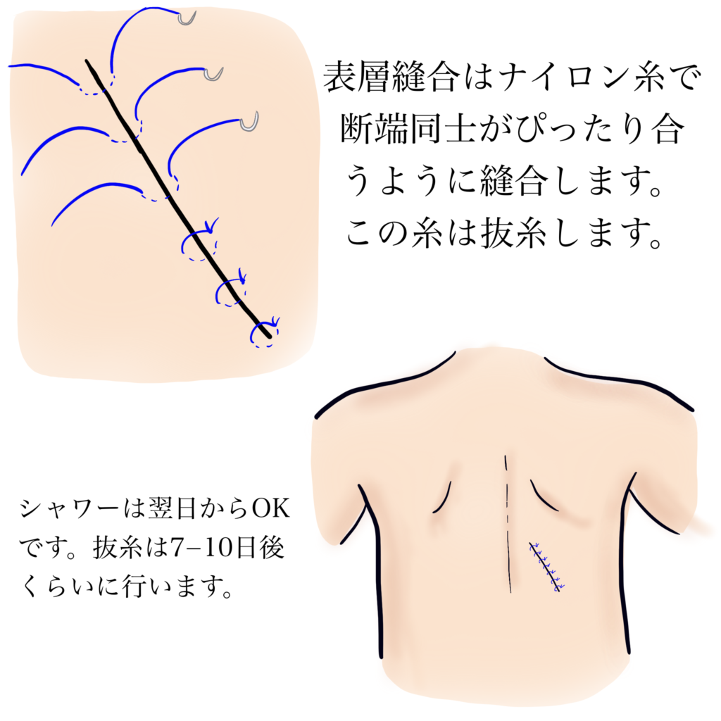 サリチル酸テープ セール 粉瘤