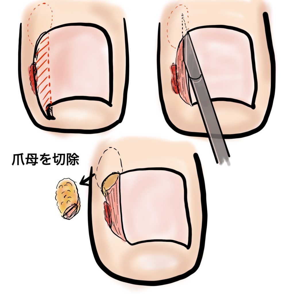 陥入爪の手術について 具体的な流れ 或る形成外科