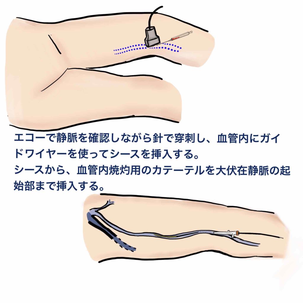 #裁断済 下肢静脈瘤 血管内焼灼術 下肢静脈瘤の血管内焼灼術 | 或る形成外科